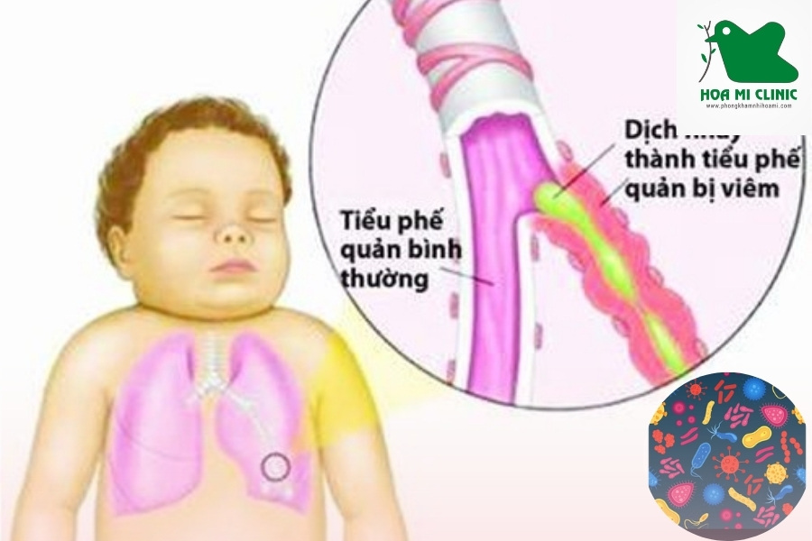 Viêm phế quản làm trẻ bị ho khan