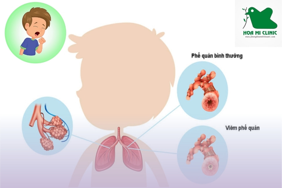 Viêm phế quản ở trẻ em có nguy hiểm không