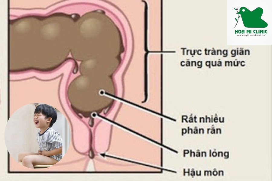 Bé bị táo bón do nhịn đi ngoài