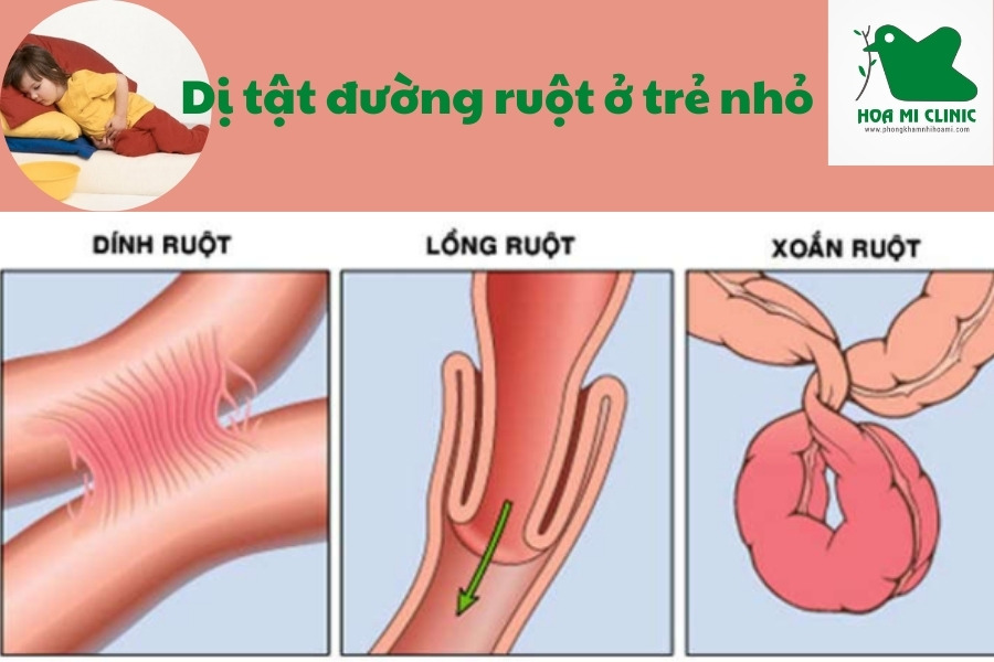 Các dị tật đường ruột ở trẻ nhỏ