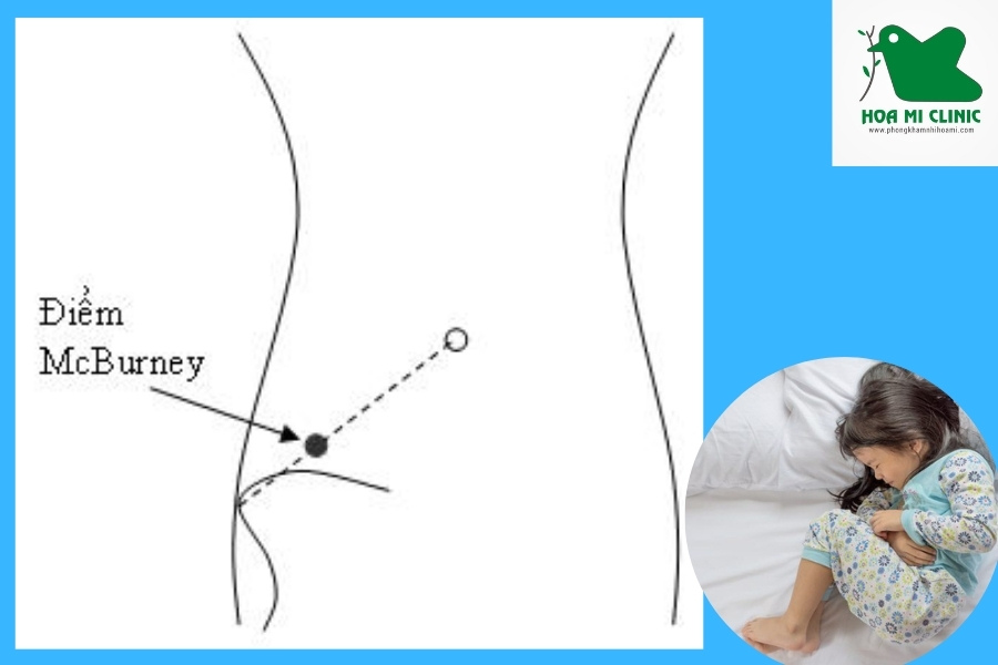 Điểm McBurney giúp xác định bệnh đau ruột thừa
