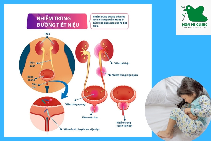 Nhiễm khuẩn tiết niệu làm trẻ em bị đau bụng dưới