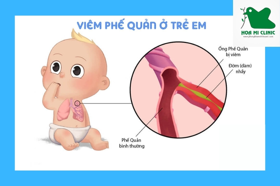 Viêm phế quản làm bé bị ho khò khè có đờm