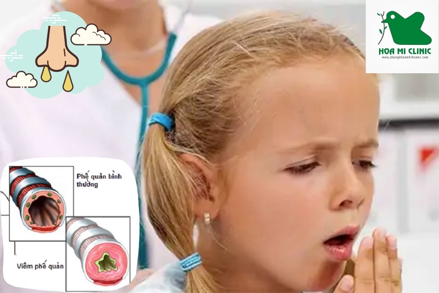 Viêm phế quản làm trẻ bị ho dai dẳng