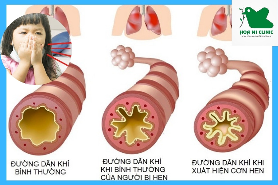 Bé bị ho do hen phế quản
