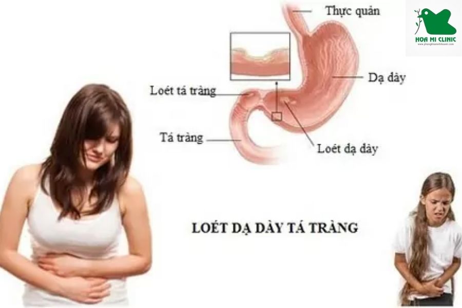 Trẻ bị loét dạ dày đau bụng quanh rốn