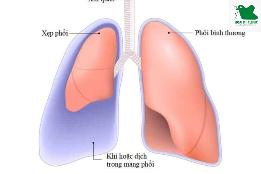 Trẻ bi hen suyễn và các nguy hiểm xẹp phổi kèm theo