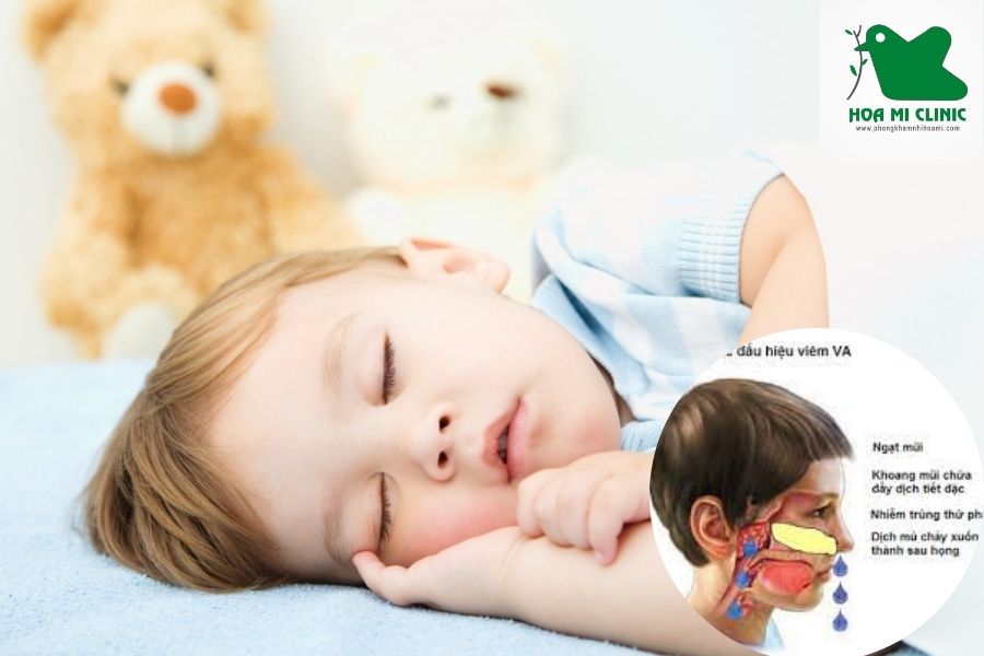 Trẻ bị nghẹt mũi khó thở khi ngủ do bị viêm VA