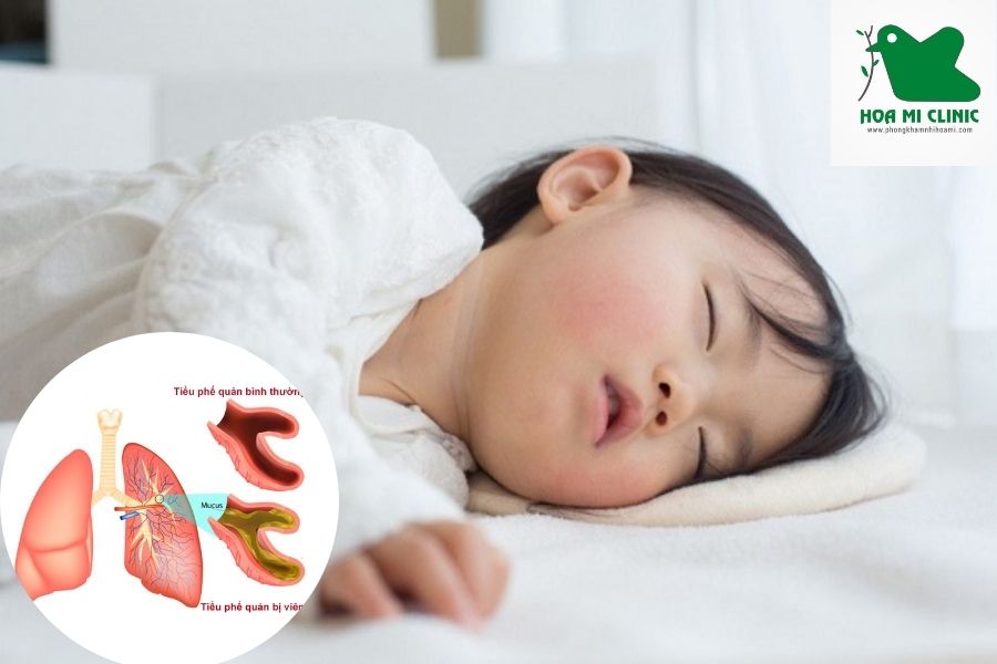 Trẻ thở khò khè do bị viêm tiểu phế quản
