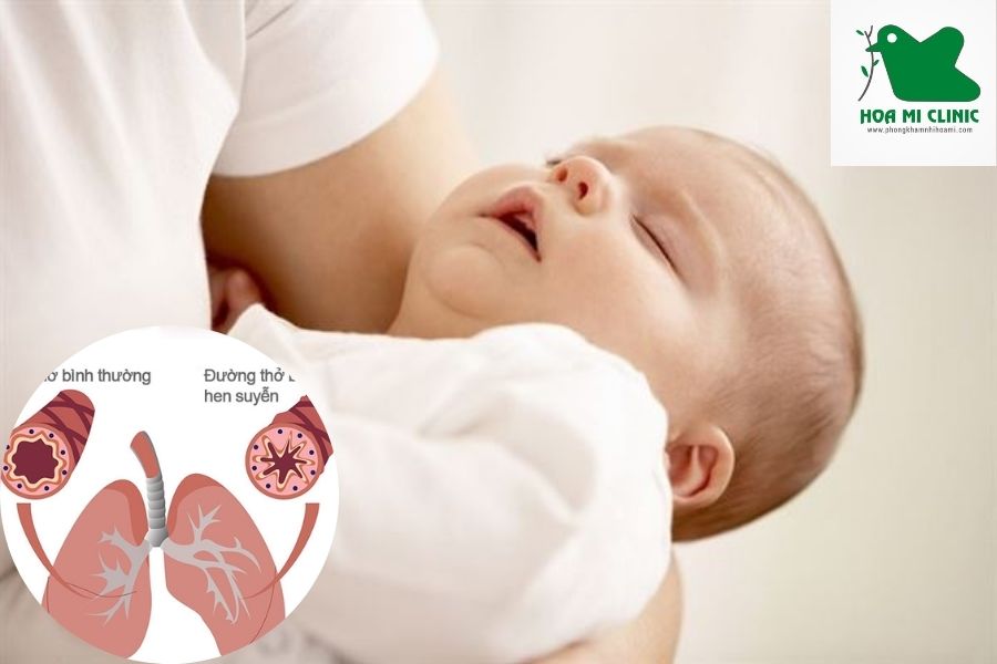 Trẻ thở khò khè khi ngủ do mắc hen phế quản