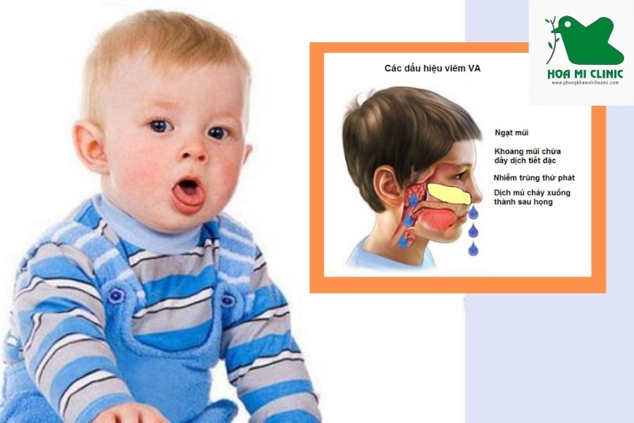 Trẻ bị khó thở nhưng không sốt do bị viêm VA