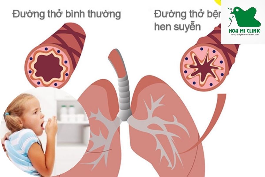 Trẻ bị khó thở nhưng không sốt do mắc hen suyễn
