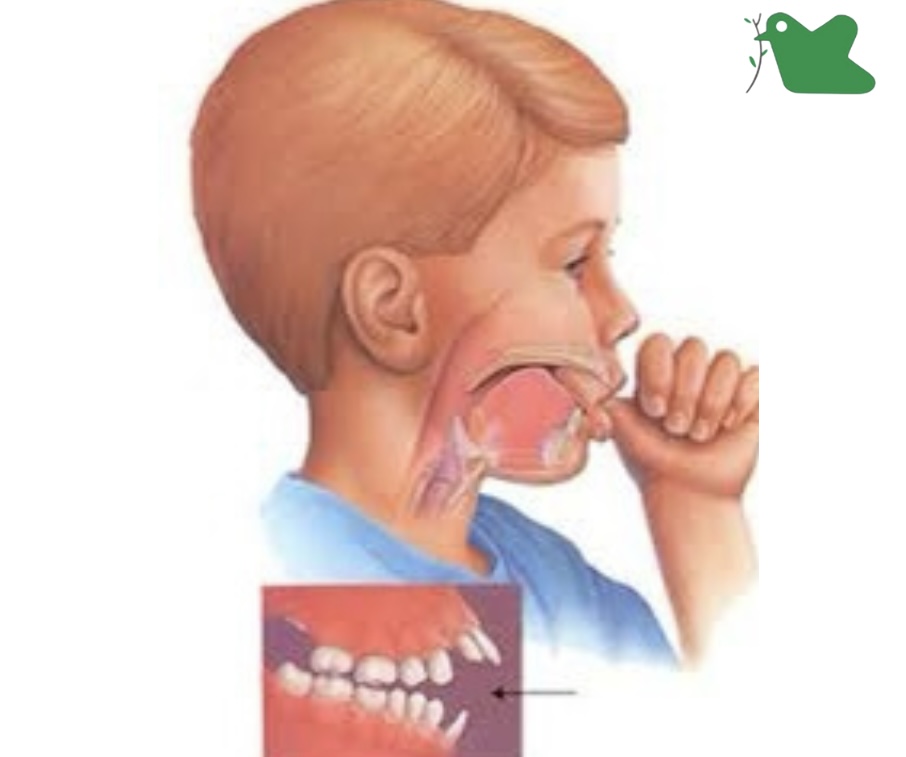 Trẻ mút tay nhiều dẫn tới biến đổi răng.