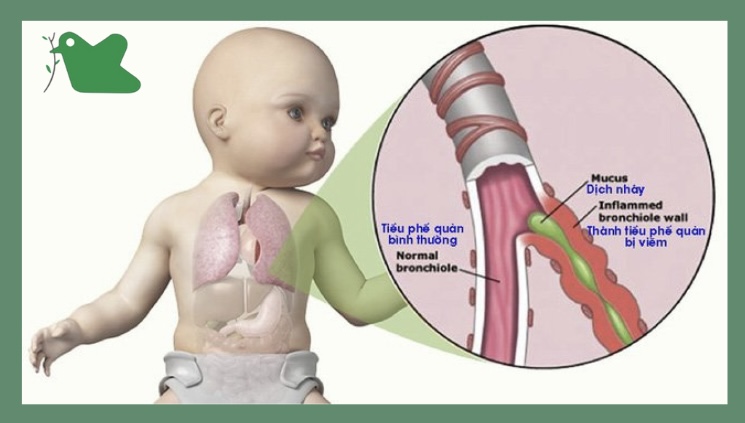 Viêm tiểu phế quản khiến trẻ sơ sinh nghẹt mũi, thở khò khè.