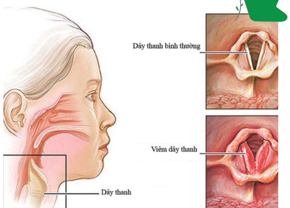 Viêm thanh quản cấp ở trẻ em