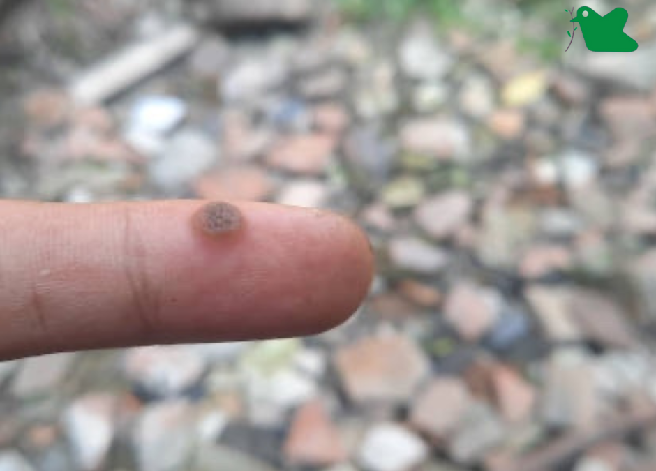 Mụn cóc có lây nhiễm không?