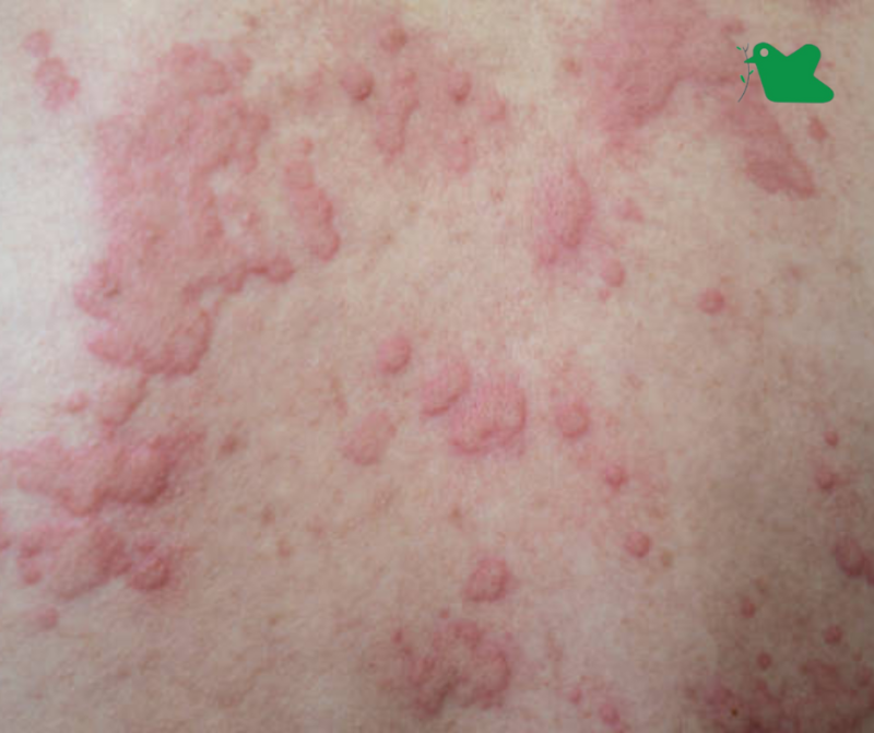 Nổi mề đay dị ứng.