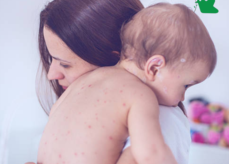 Một số dị ứng thường gặp ở trẻ nhỏ.