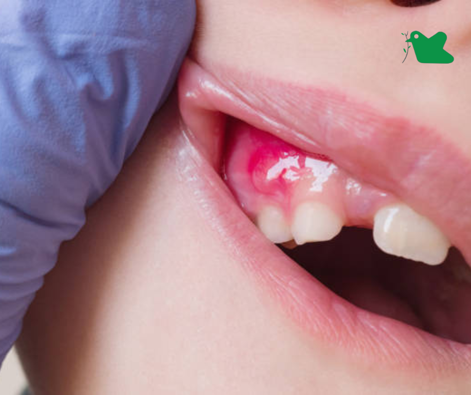 Trẻ bị nhiệt miệng.