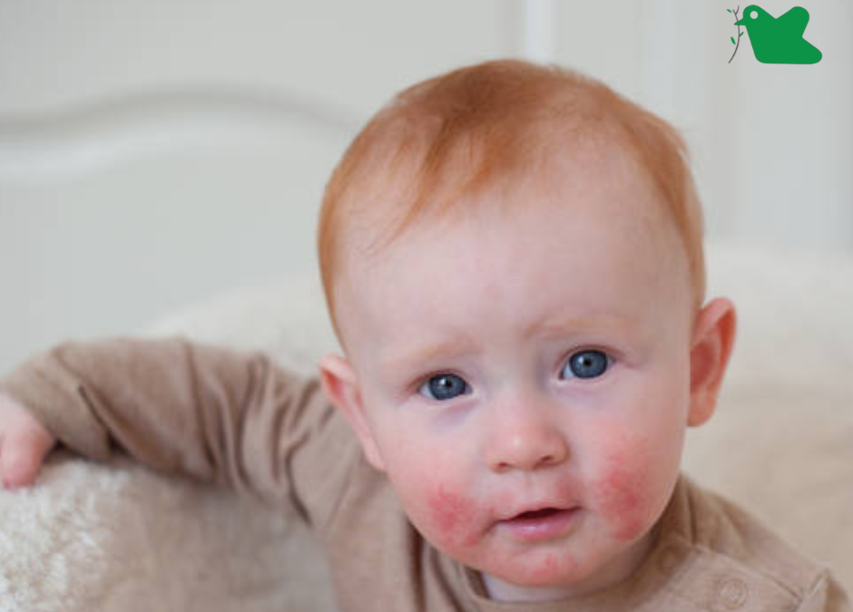 Nhận biết trẻ dị ứng sữa công thức