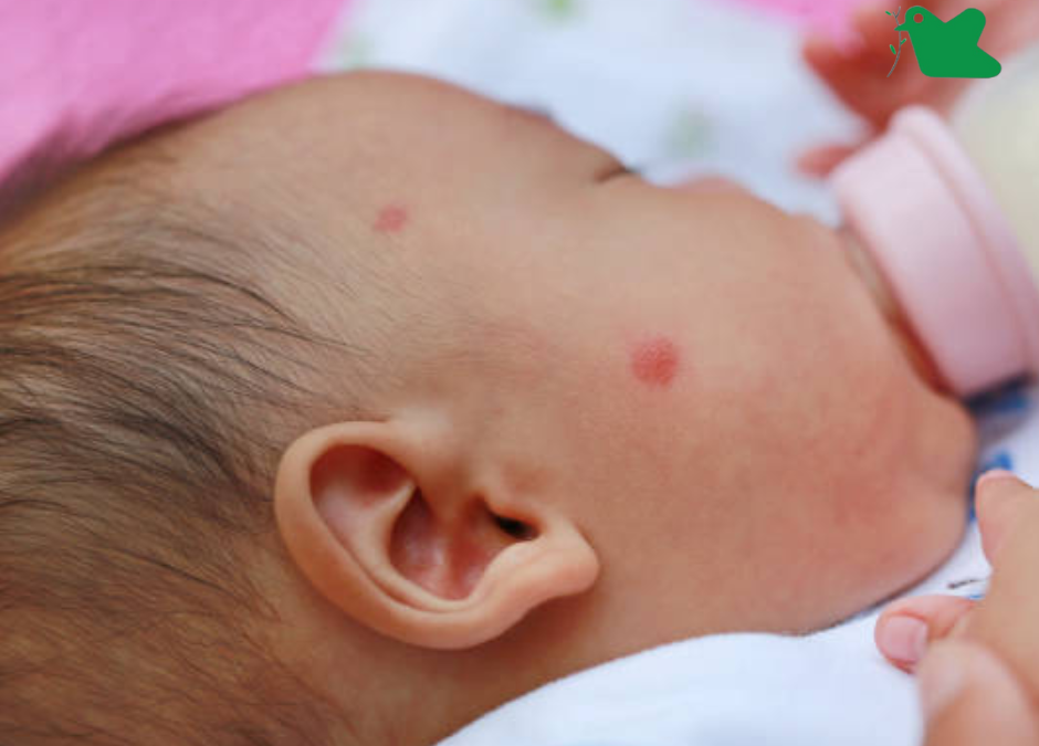 Dị ứng đạm sữa bò.