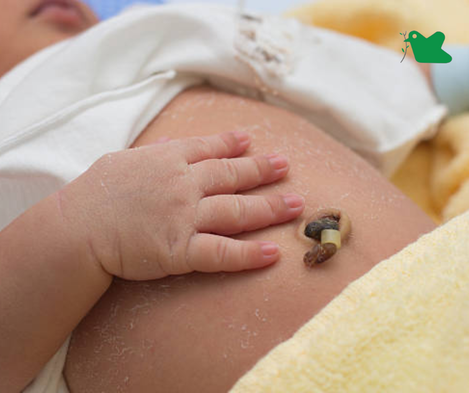 Chăm sóc rốn cho trẻ sơ sinh.