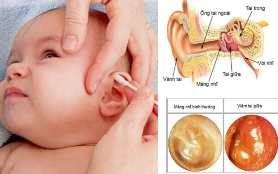 Nguyên nhân viêm tai giữa ở trẻ
